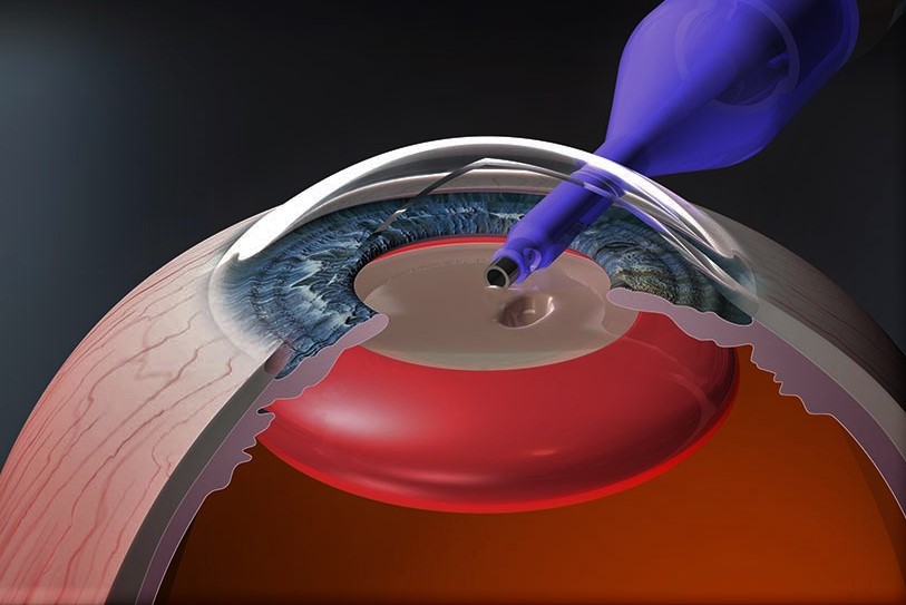Лікування катаракти: важливість співробітництва з професійною клінікою