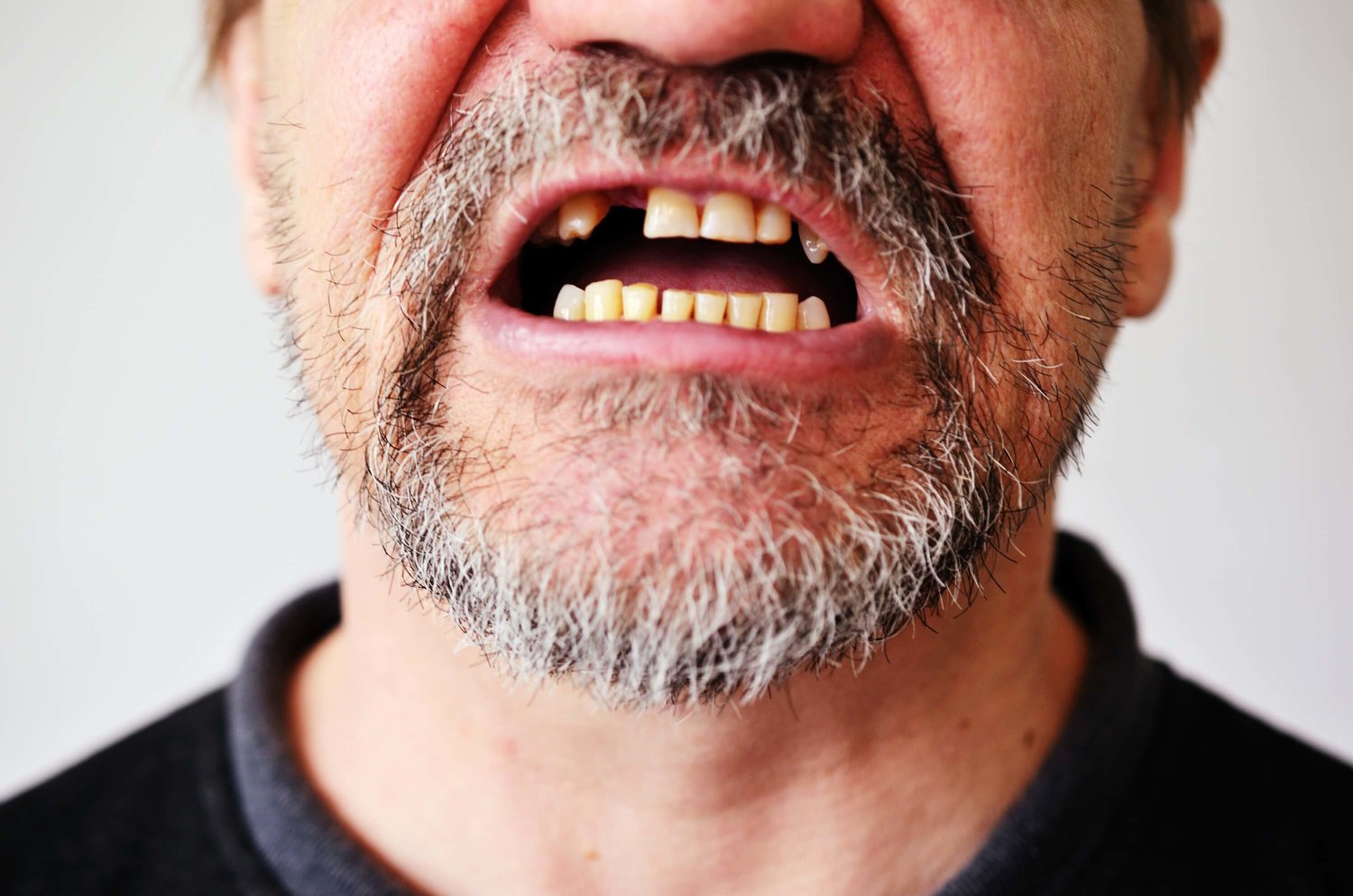 10 основных причины потери зубов у людей