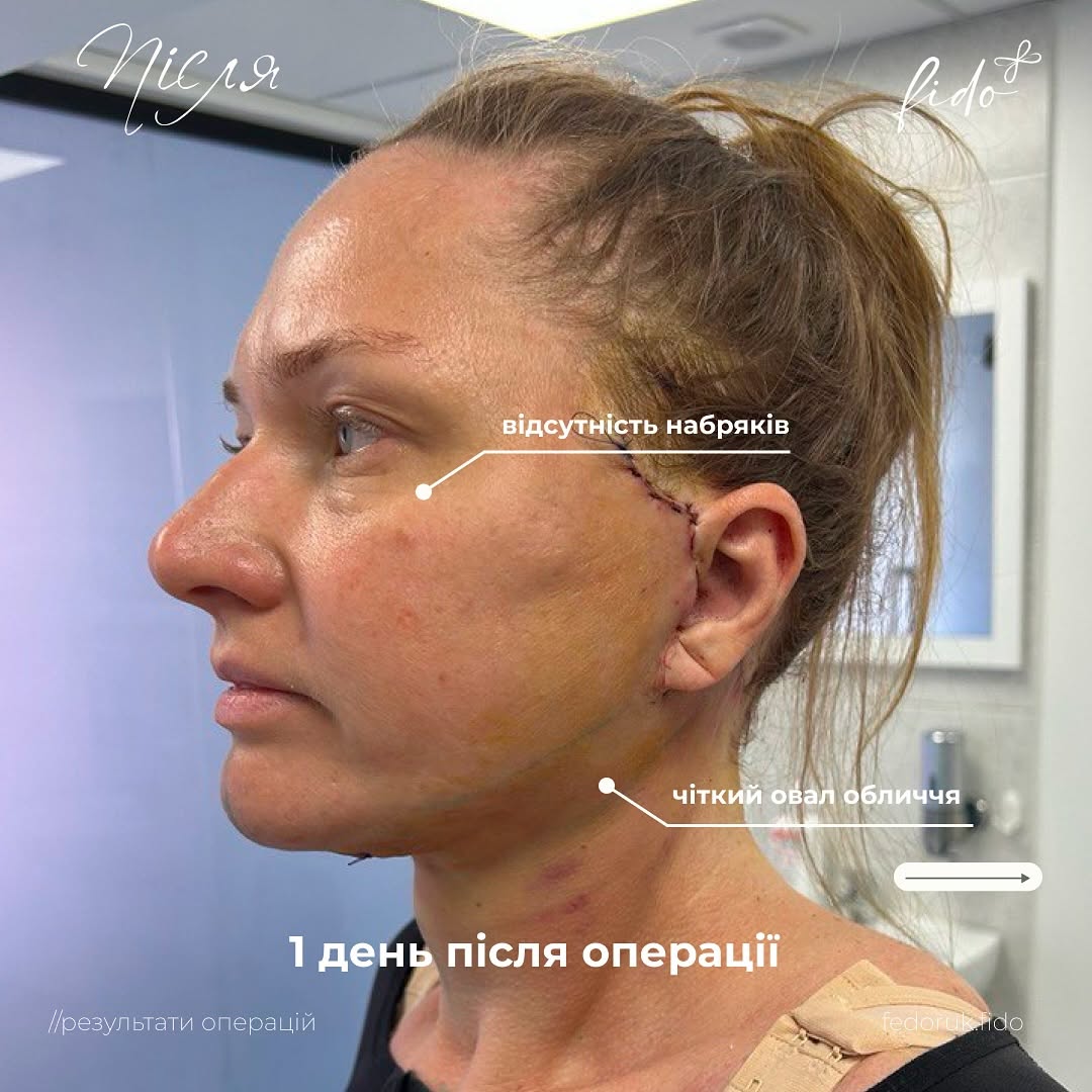 Подтяжка лица - современный взгляд на процедуру, методики и результаты